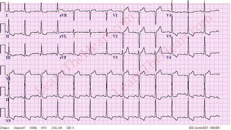 lv strain adalah|lvh strain pattern.